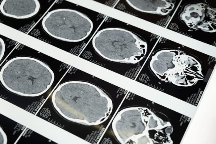 Brainwaves and the connection with sleep Brainwaves and the connection with sleep